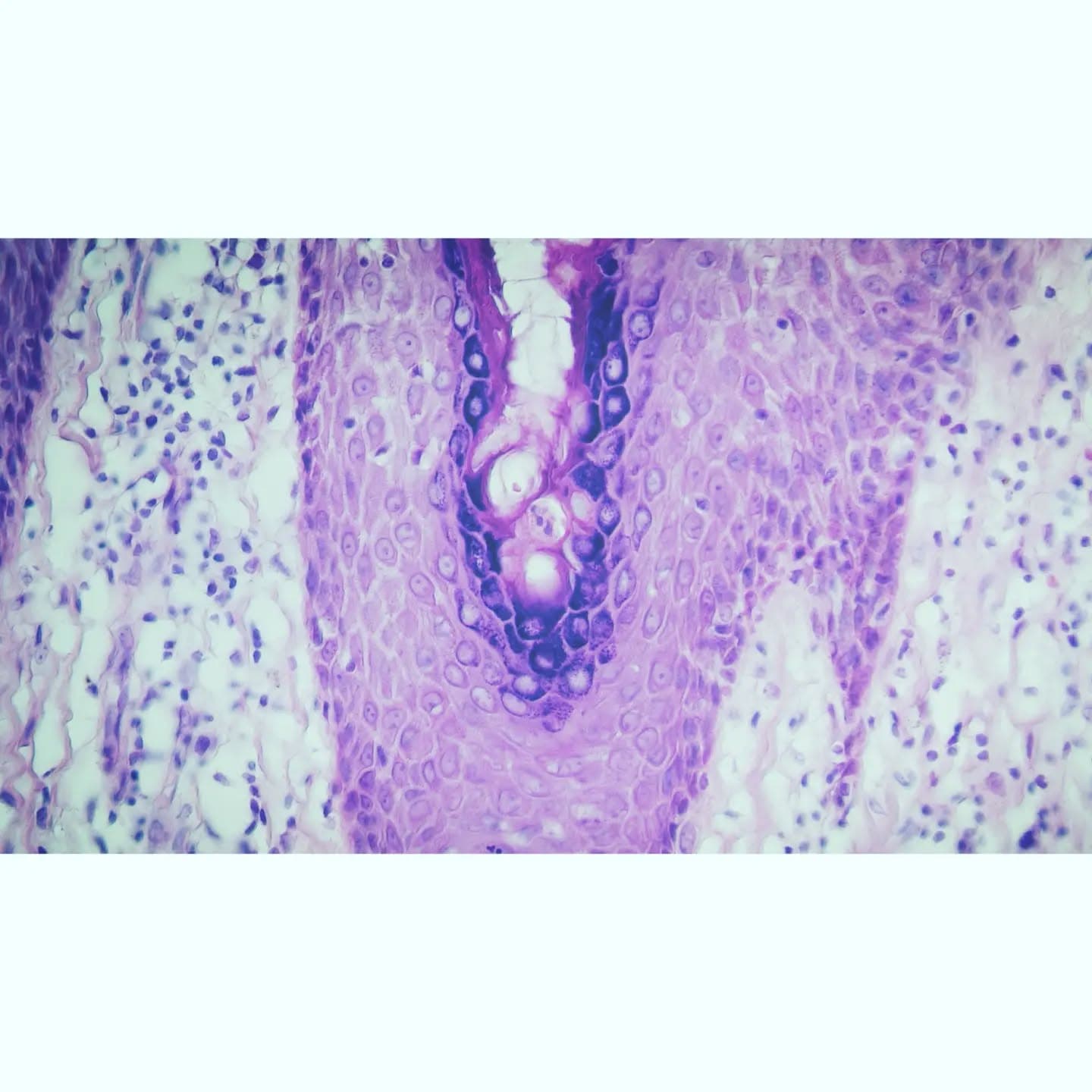 An 85 y/o male with an old skin lesion on leg
A quite symmetrical skin lesion with hypergranulosis, papillomatosis and inward bending of rete ridges.
Intracorneal hemorrhage (slide 4), focal margination of keratohyaline globules(slide 5) and occasional cytoplasmic vauolation of superficial keratinocytes (slide 6)
Dx: Verruca vulgaris