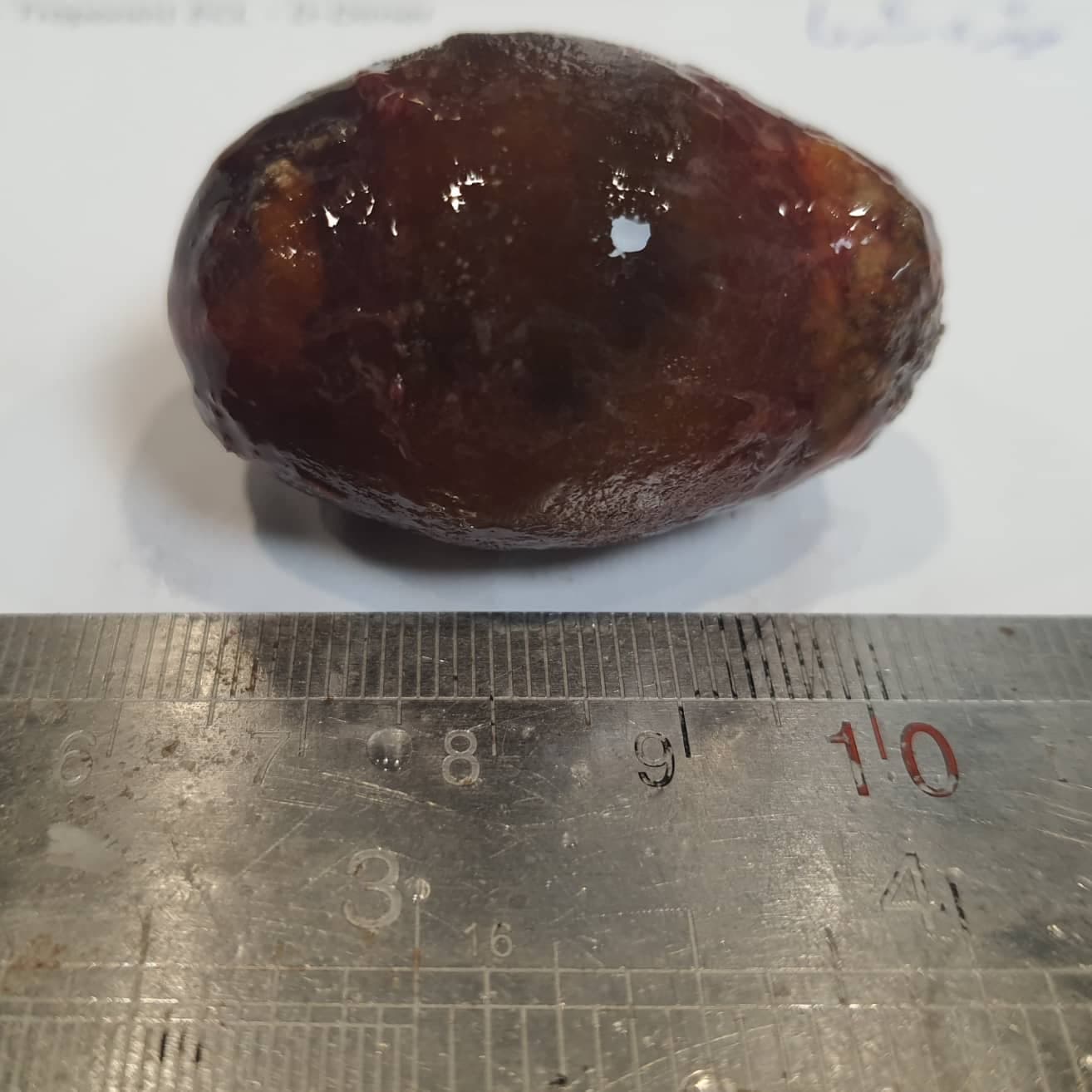 How acute cholecystitis may look like in gross exam with diffusely hemorrhagic mucosa and a large cholesterol stone stuck in its neck