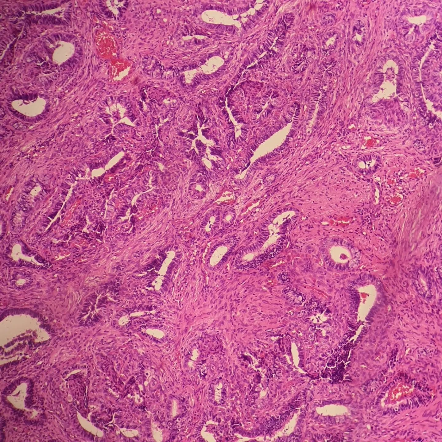 A 46 y/o female with complaint of AUB, sonographic exam showed an endocervical polyp with endometrial thickness of 7mm,
and here it is, the amazing "atypical polypoid adenomyoma (APA)":
lobular architecture in low power, biphasic lesion composed of endometrioid glands with complex architecture in a fibromyomatous stroma and very common squamous morules.
@taghipoursalameh
