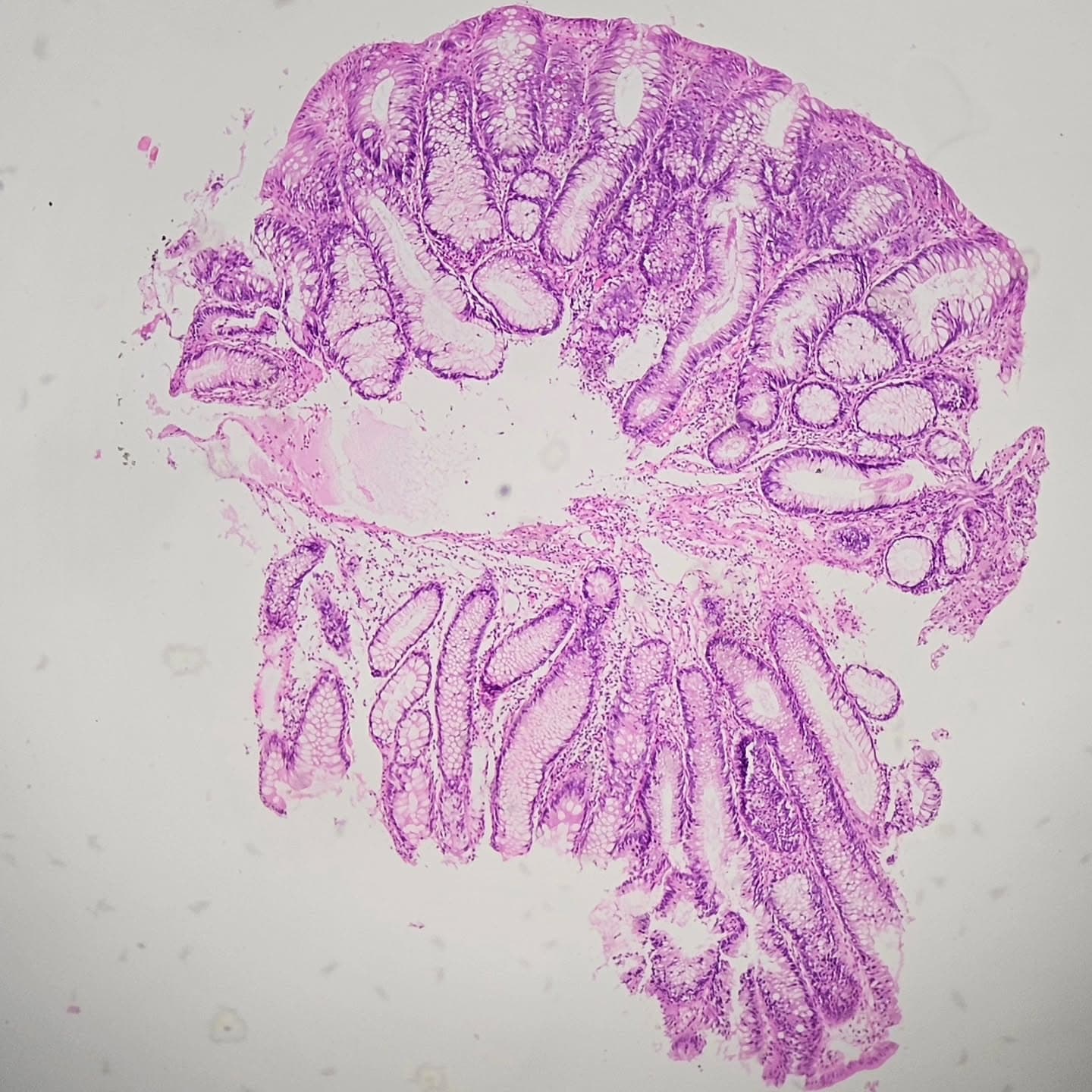 A 50 y/o female with a cecal polyp (0.7cm).
Dx: Sessile serrated lesion (also known as sessile serrated adenoma/polyp)
