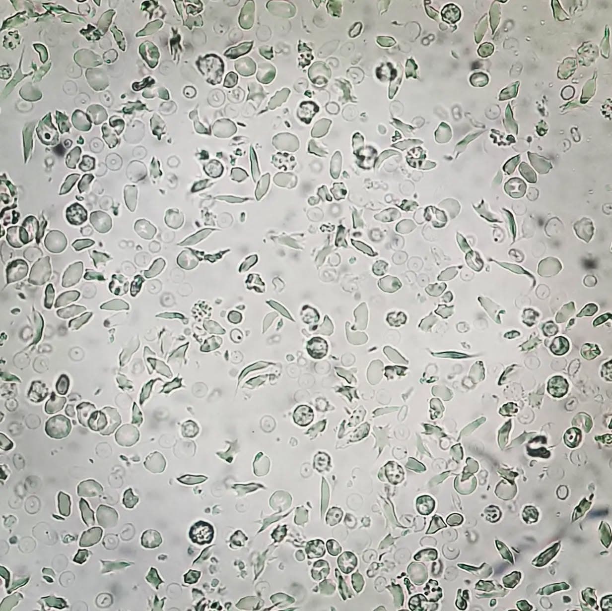 A case of sickle cell anemia with Hb: 7.1, MCV: 85, MCH: 27, MCHC: 31, WBC: 11'400, plt: 233'000.
Slide 3-5: very nice metabisulfite test