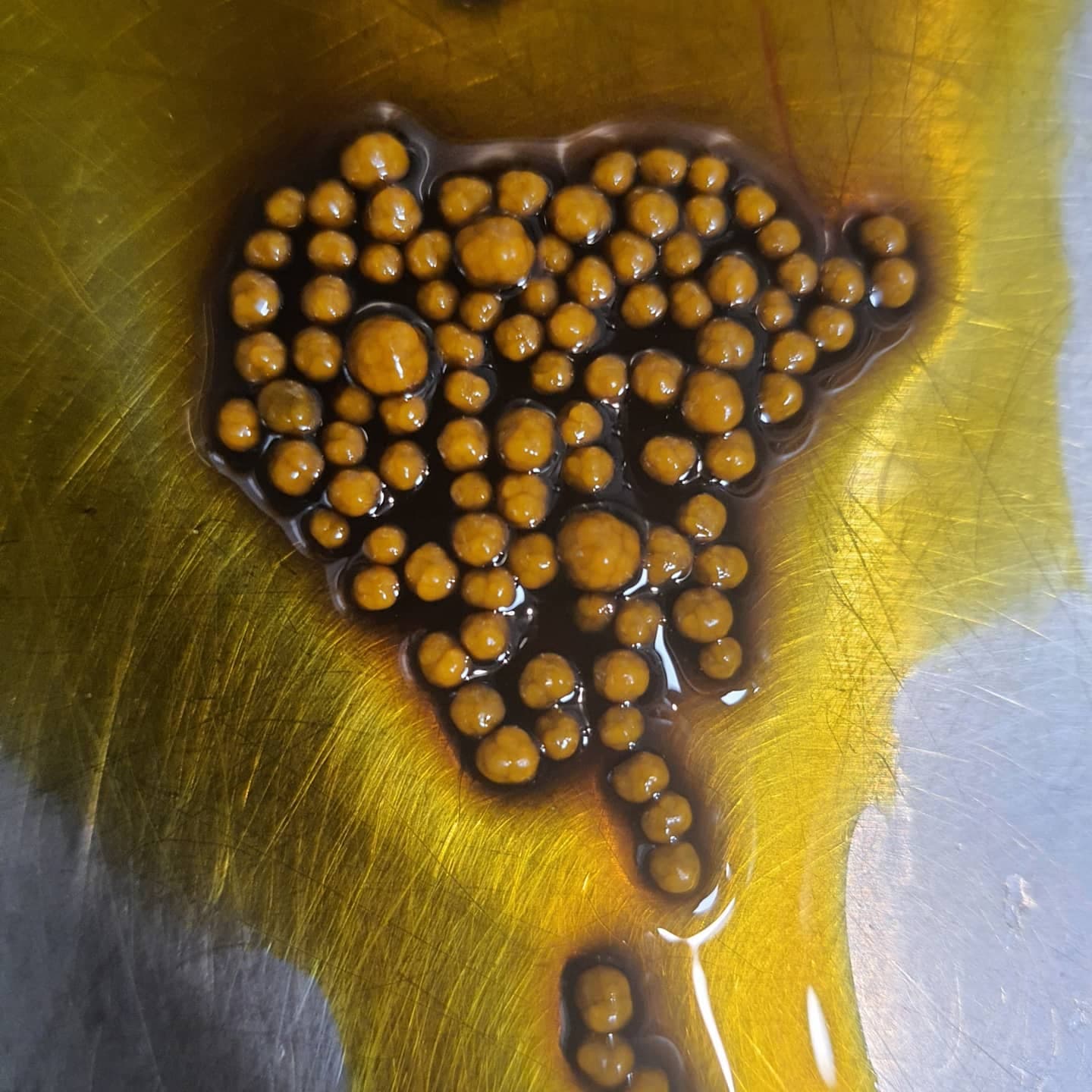 Nice monomorphous gallbladder stones with impeccable resemblance to a bunch of pearls