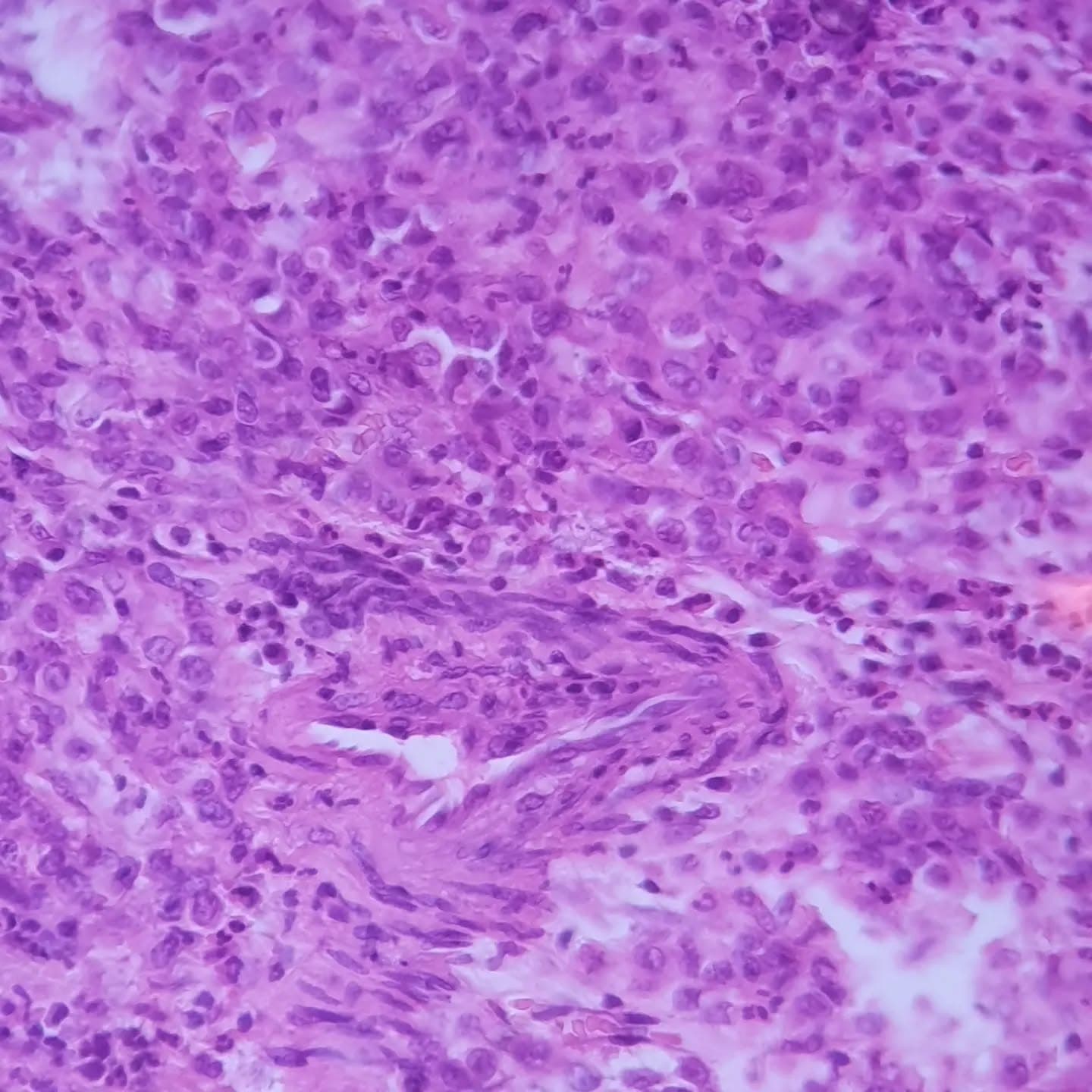 Terrifying poorly differentiated gastric adenocarcinoma with signet ring features.. Marked pleomorphism of tumor cells with many atypical mitotic figures,
forming glands in a small foci (slide 4), invading through muscularis propria layer and beyond (slide 9)
and its cruel lymphovascular invasion
(slide 10: a lonely vessel surrounded by attacking malignant cells)