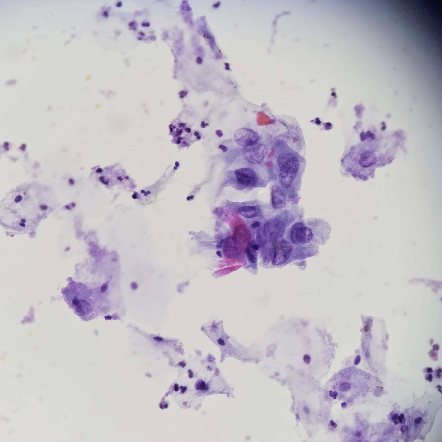 Routine pap smear
Presence of squamous cells with enlarged hyperchromatic nuclei and irregular nuclear borders
Dx: LSIL
Further work-up: positive HPV 16 molecular test