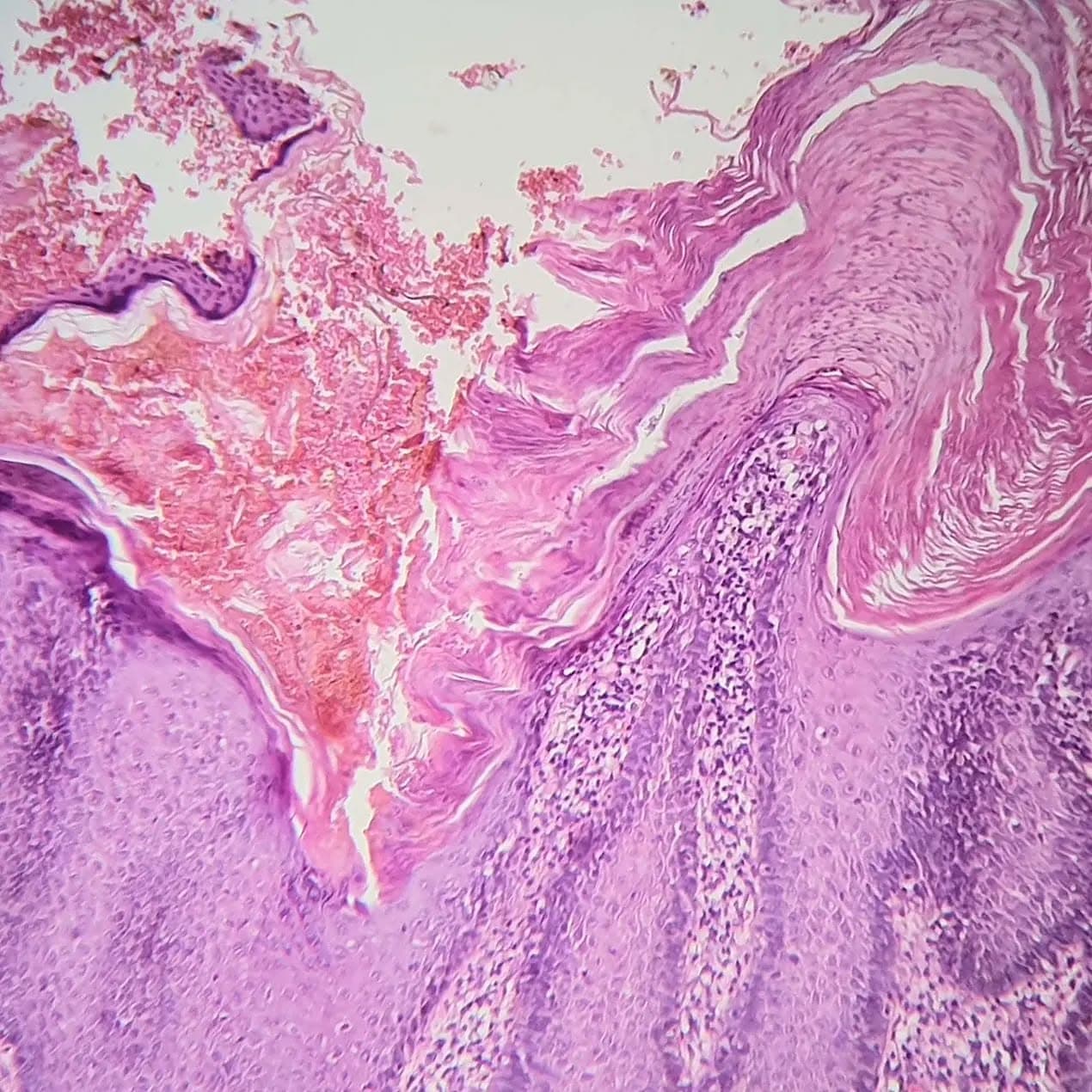 A 64 y/o female with a lesion on face
Skin tissue with papillomatosis, acanthosis and hyperkeratosis with a flat base
Dx: Seborrheic keratosis, hyperkeratotic type
Main ddx: Verruca vulgaris