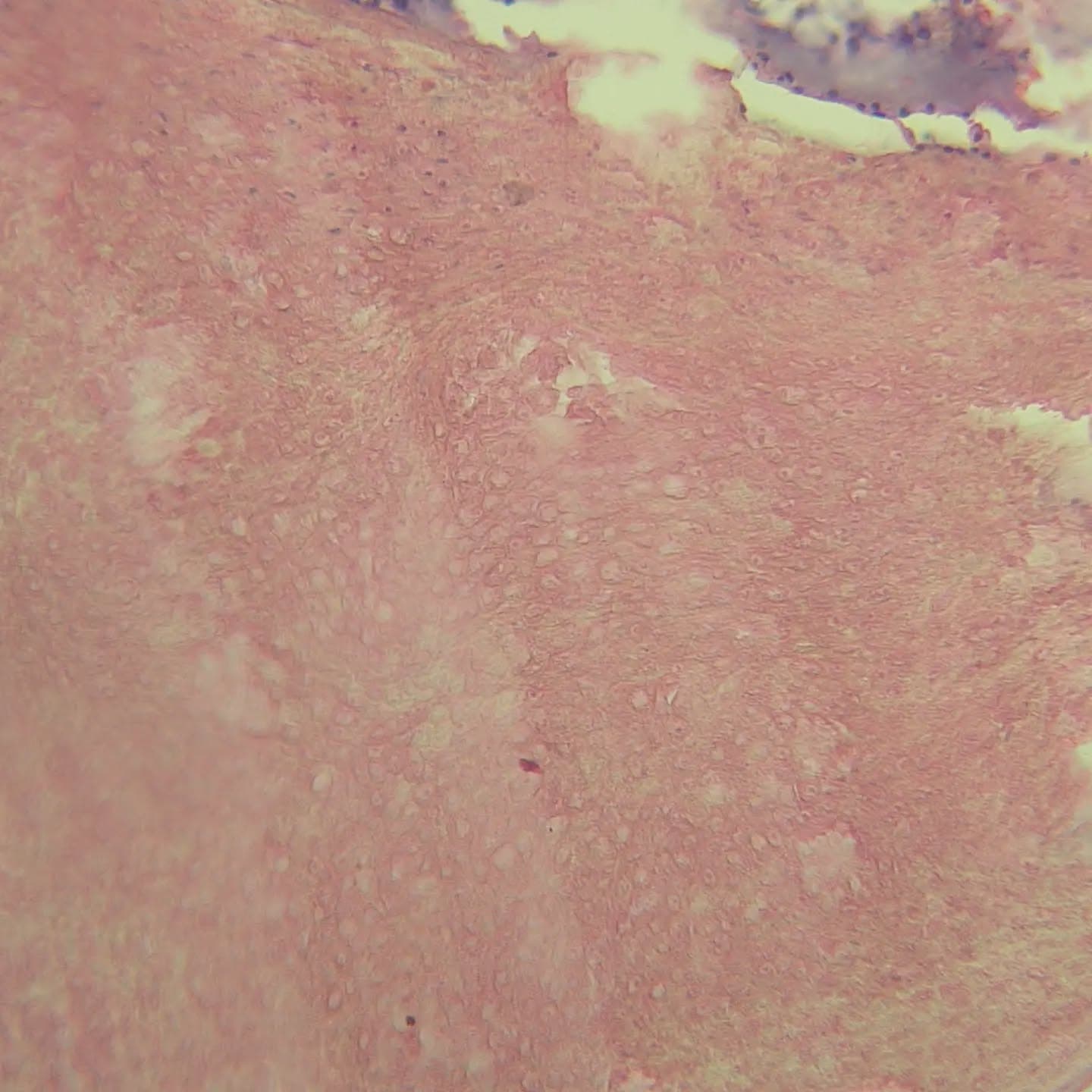 And here it is.. bilateral pilomatrixoma!
An 8 y/o boy with bilateral soft tissue lesions at the location of scapula,
Islands of anucleate cells (ghost cells) with basophilic cells at the periphery of the lesion making the diagnosis easy to make 😊