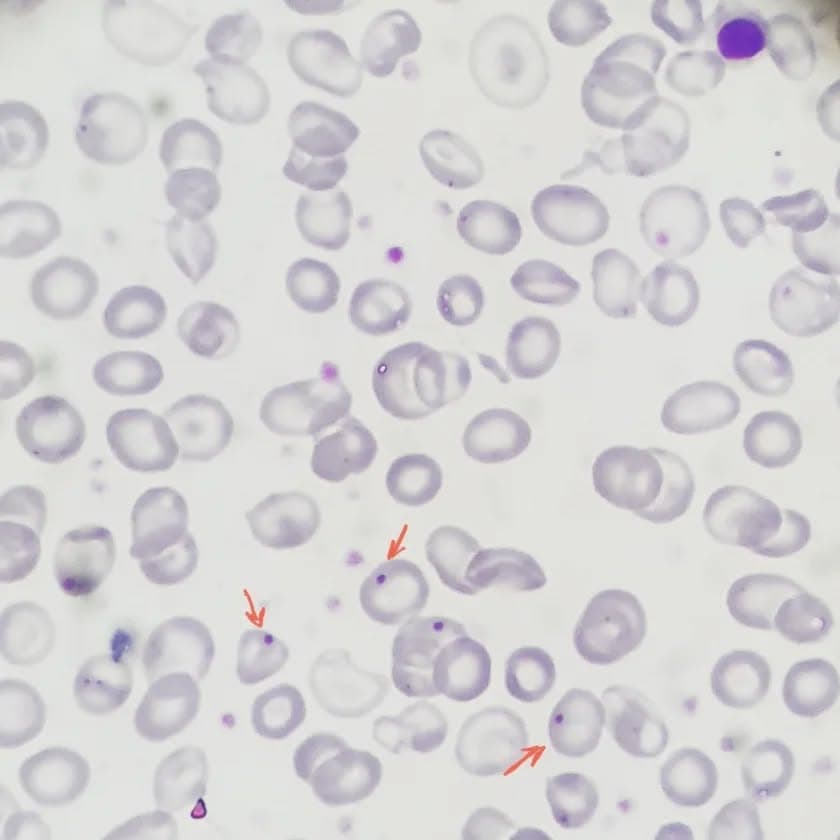 A case of beta thalassemia major who has undergone splenectomy.
On peripheral blood smear howell jolly bodies as well as many target cells are present as a consequence of splenectomy.