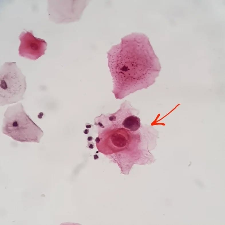 A 35 y/o female, asymptomatic with a liquid based pap smear for routine screening
Very slight inflmmation with these cells showing obvious halo with dense chromatin and nuclei (×3 or even more in nuclear size in comparison to adjacent intermediate squamous cells), signed out as "LSIL" and recommended HPV molecular testing
Later the test was performed and the patient was positive for high risk HPV (slide 10)