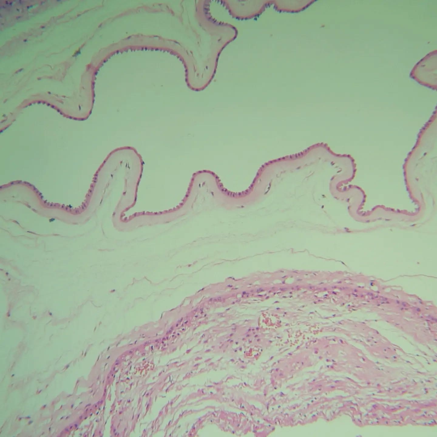 IUFD in a 27 y/o female (GA: 32w)
Infiltration of neutrophils in chorion, early chorionitis/acute subchorionitis (stage 1)