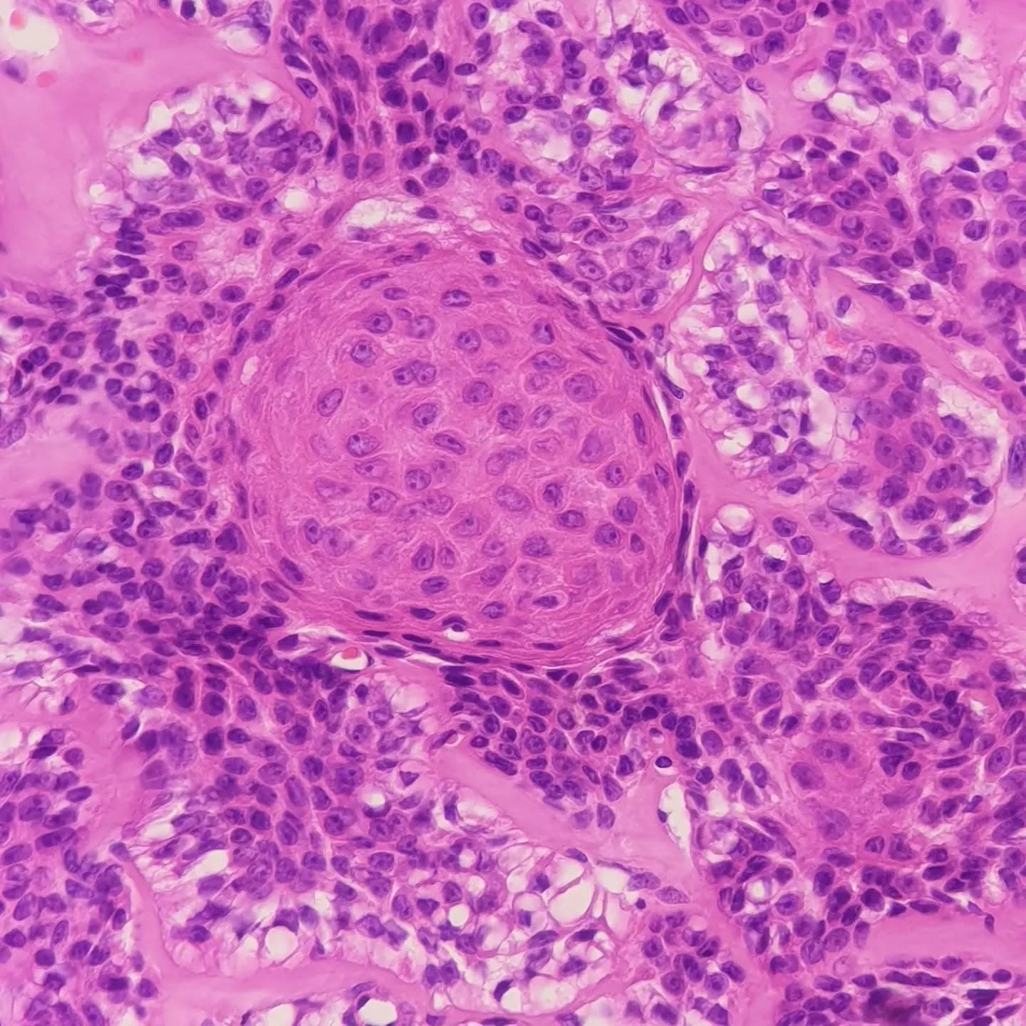 A 46 y/o woman with a sole lesion.
A well-defined mass with epithelial lobules composed of two cell populations (slide 1, 2, 6, 7):
1. Polygonal cells with eosinophilic cytoplasm, arranged in whorls (slide 8),
2. Cells with clear cytoplasm and a small dark eccentric nuclei (slide 4).
Few duct-like structures were seen (slide 5). Some cystic areas were also found (slide 9).
Squamous differentiation and keratin pearls (slide 2, 3), as well as sebaceous differentiation (slide 10) were identified.
The lesion has it all for the diagnosis of HIDRADENOMA!
