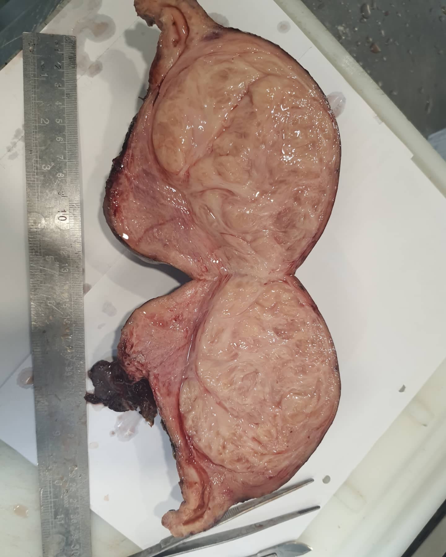 Very large intramural myoma (M: 12cm in greatest dimension) with nice whorled pattern in cut section