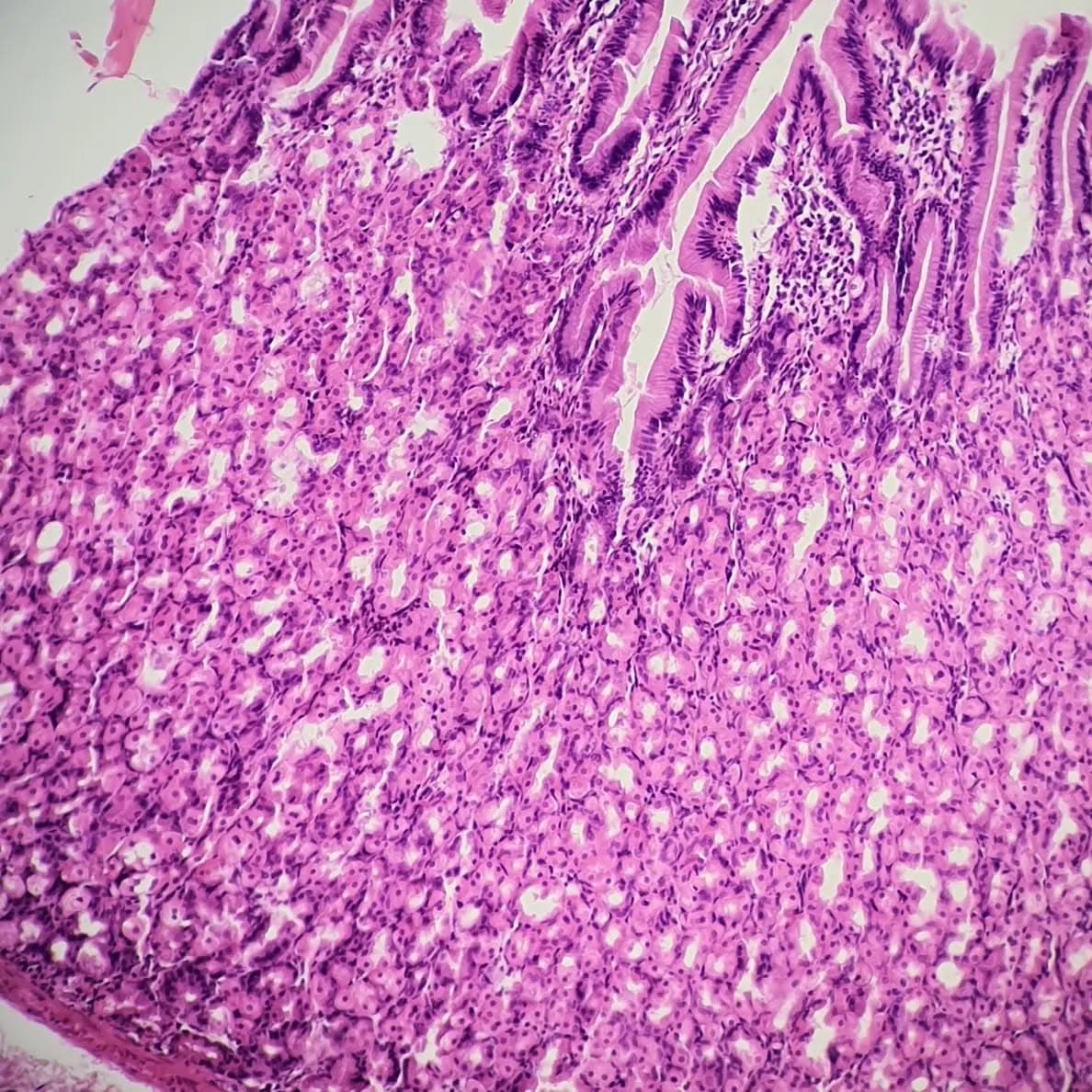 Resected as "Meckel diverticulum"
On gross examination, an ill-defined polypoid elevated area on mucosal surface was seen.
Microscopic exam revealed ectopic oxyntic gastric mucosa!!
Gastric mucosa is the most common ectopic tissue found in meckel diverticulum followed by ectopic pancreatic tissue.