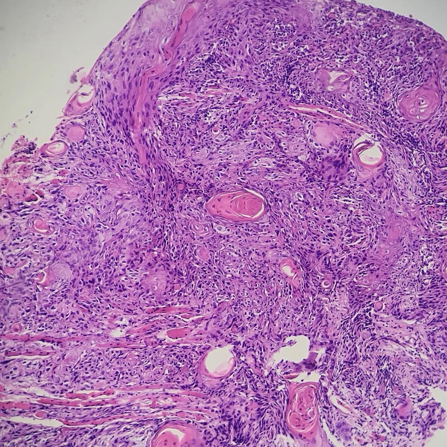 Well-differentiated SCC of tongue, keratinizing
With entrapment of skeletal muscle bundles between tumor cells (slide 5, 6)