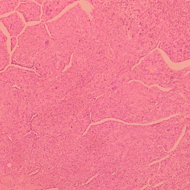 History of uterine leiomyosarcoma and metastasis to lung, again with multiple lung metastases..
In microscopic exam prominent pleomorphism and easily indentifiable mitotic figures including atypical ones are noted. Staghorn vessels are found all throughout the tumor.