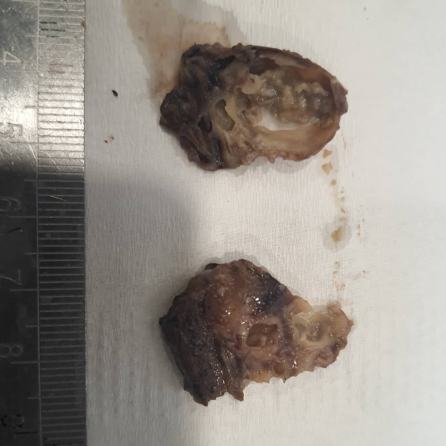 How a lung with bronchiectatic changes looks like in gross exam..distended peripheral bronchi with accumulation of intraluminal inspissated secretions