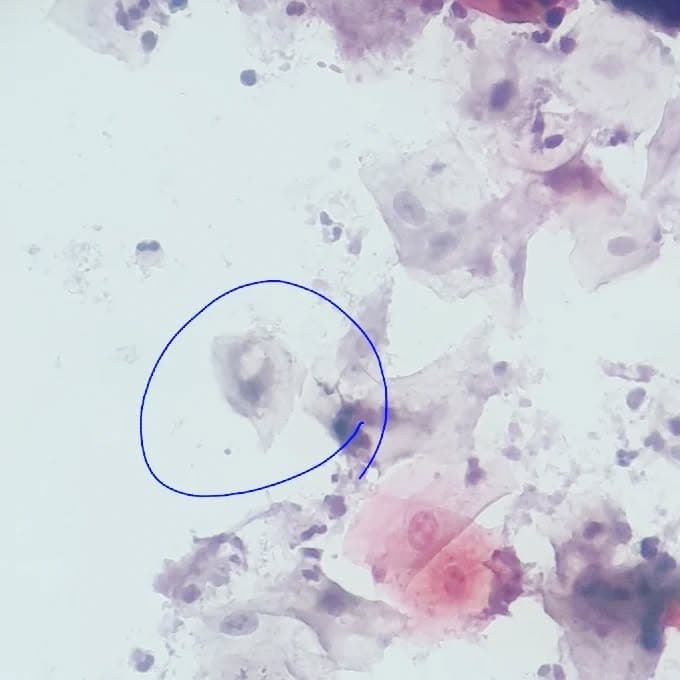 A 21 y/o female with vaginal discharge and pruritis, no history of recent lactation or pregnancy, no history of IUD insertion..
In liquid-based pap smear severe inflammation, candida yeasts and hyphae identified.
Clamydia cytopathic change?? Maybe...