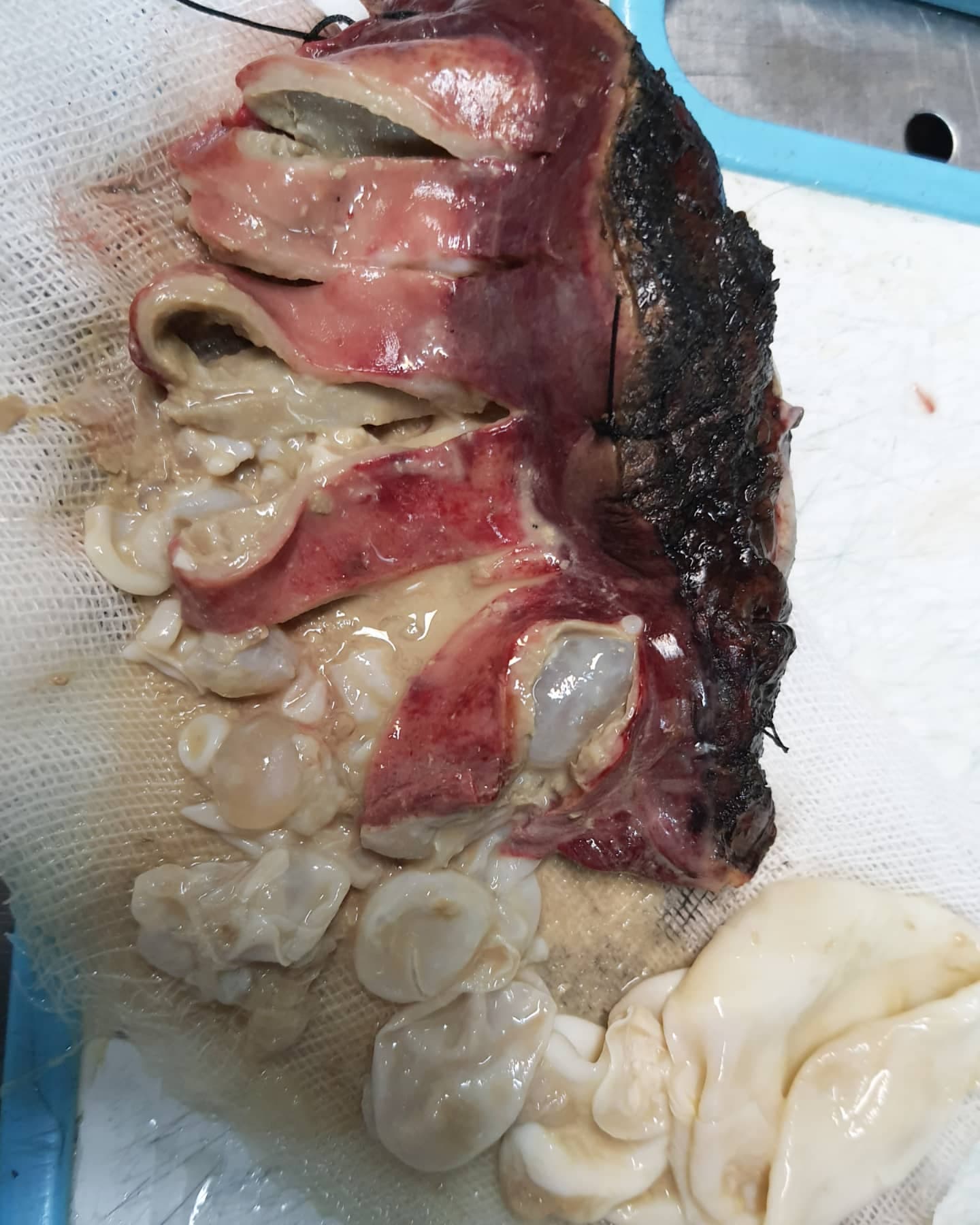 Liver mass
On cutting, many daughter cysts came out of the so-called mass, making the diagnosis …