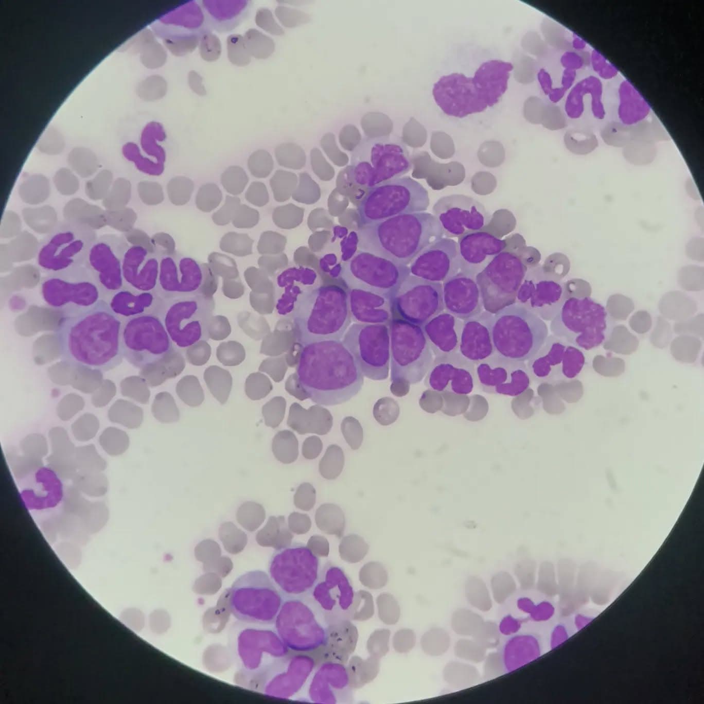 Hard to believe that the slides are from peripheral blood and not bone marrow! A 35 y/o male with complaint of left upper quadrant pain...Abdominal ultrasound exam revealed splenomegaly, CBC showed WBC: 204'000, HB: 10.6 and platelet 189'000. On peripheral blood smear shift to left with predominance of neutrophils, bands and myelocytes was identified. Fewer than 10% blasts were also seen. The patient was referred for BCR-ABL1 testing with diagnosis of CML.
(Slide 6: an incredible increase in buffy coat!)
@latif.ajdary
