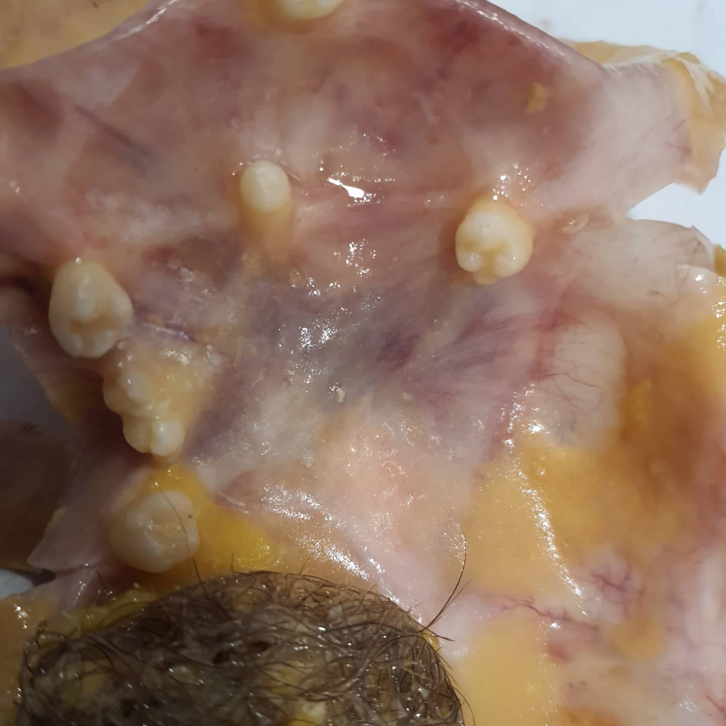 How many well formed teeth have you ever seen in a mature cystic teratoma? 😁😄