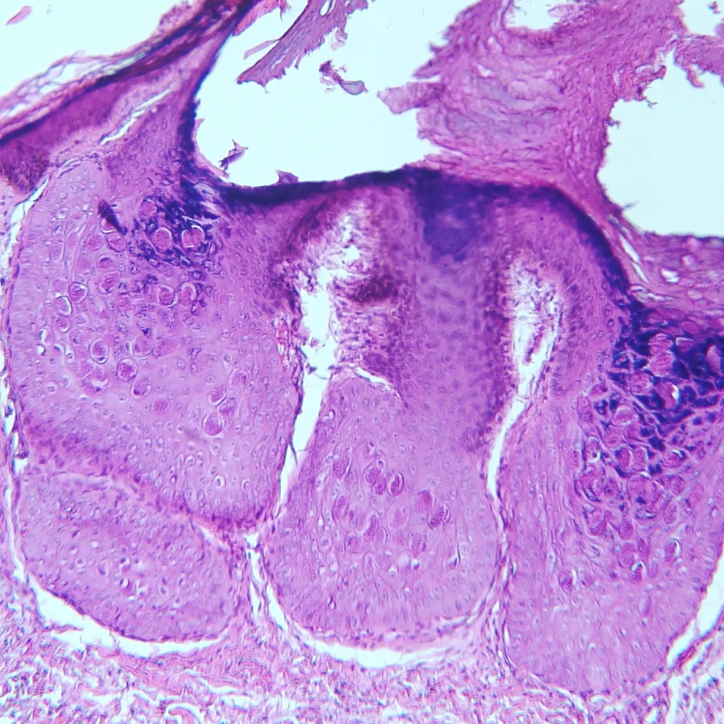 A 37 y/o female with thigh skin lesion.
Dx: Molluscum contagiosum and intradermal melanocytic nevus! Located adjacent to each other