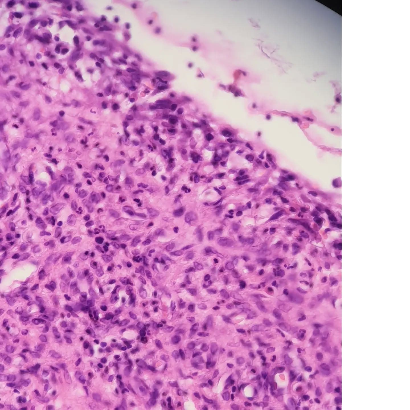 An 11 y/o male with a lower lip lesion
A cyst like structure lined by abundant foamy histiocytes and neutrophils.
The adjacent salivary gland shows lymphoplasmacytic infiltrate and ductal dilation.
Dx: mucous cyst (mucocele)