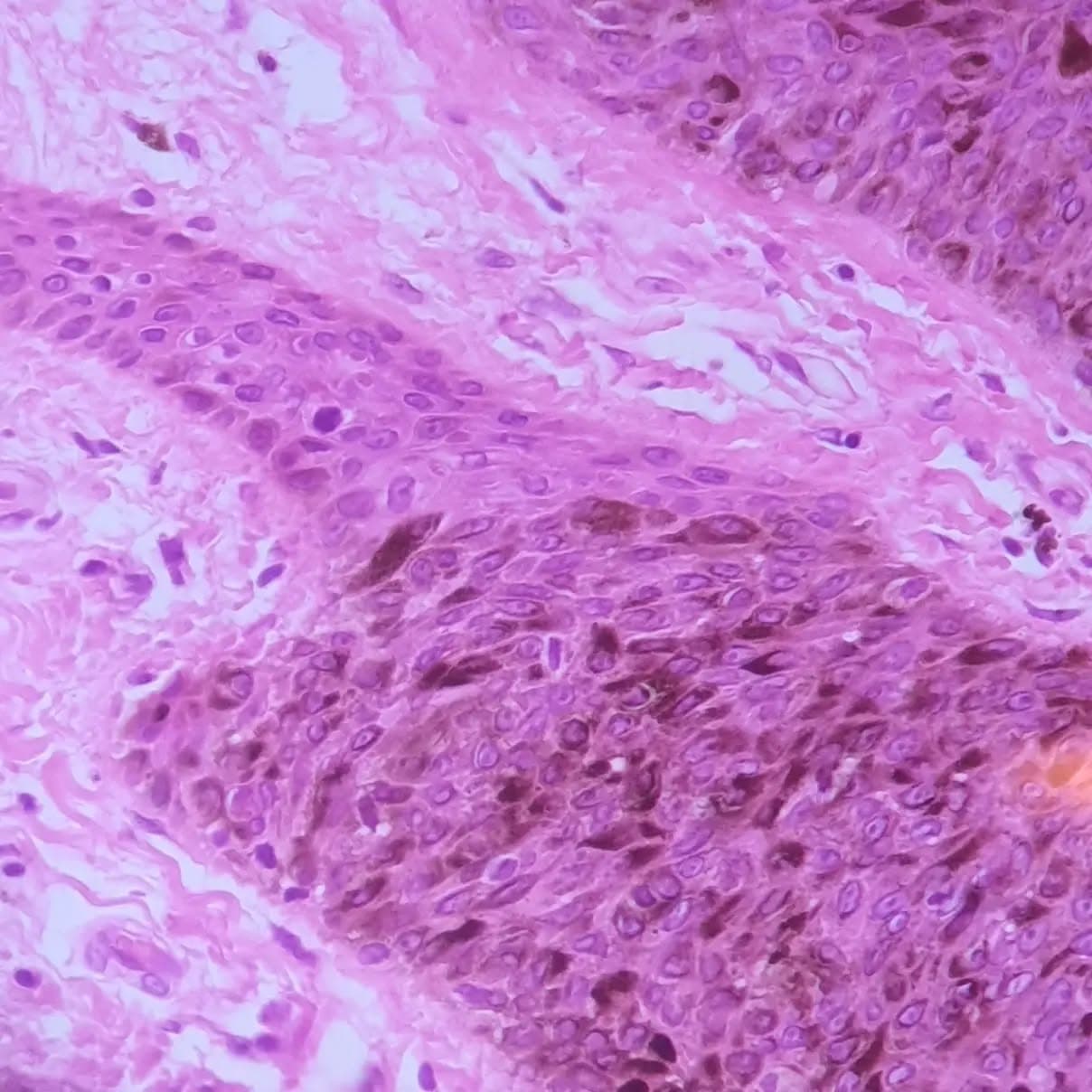 Pigmented lesion on face and suspicion of malignancy...
Dx: Pigmented seborrheic keratosis