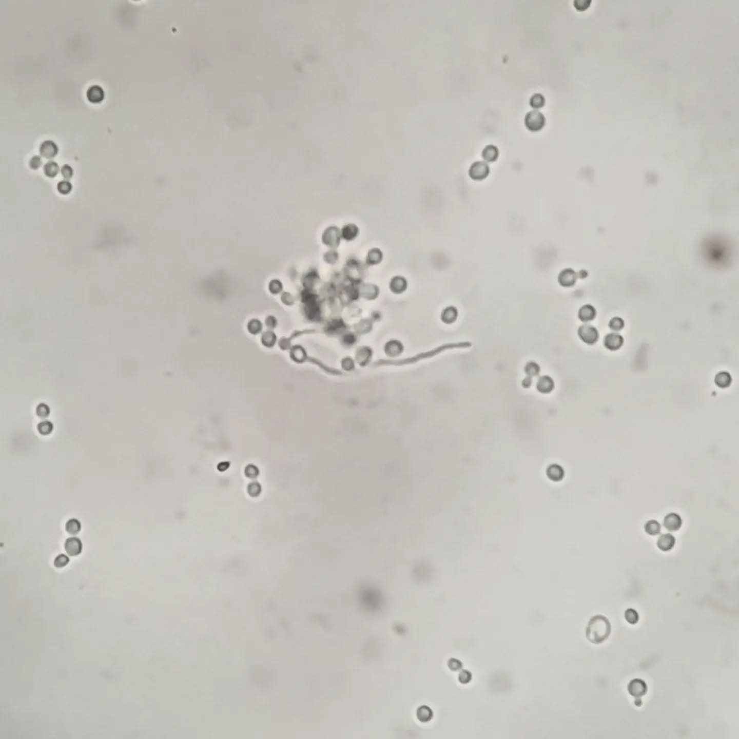 Amazing germ tube test performed on urine specimen indicative of candida albicans