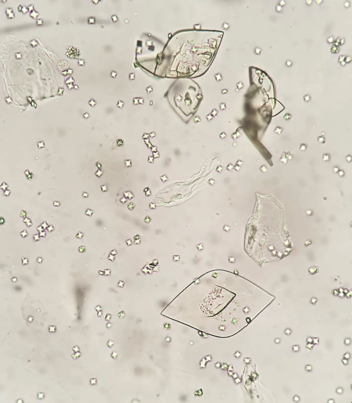 Urine analysis, microscopic exam, many amazing calcium oxalate and some uric acid crystals …